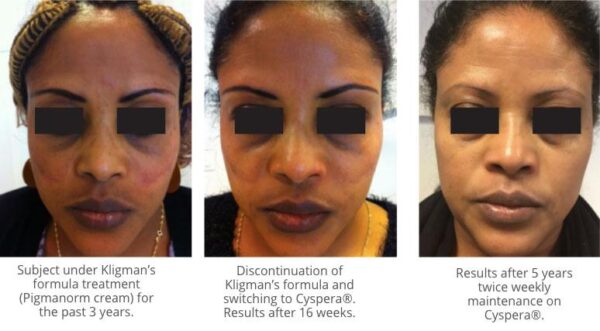 Cyspera Intensive Pigment Corrector for Hyperpigmentation - The ...